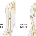 Fractures d'un os - crédits : © Encyclopædia Britannica, Inc.