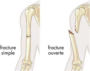 Fractures d'un os - crédits : © Encyclopædia Britannica, Inc.