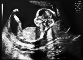 Échographie d'un fœtus de 4 mois - crédits : © J. Pavlinec/ Shutterstock