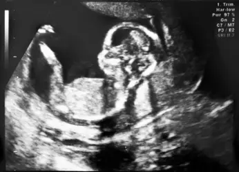 Échographie d'un fœtus de 4 mois - crédits : J. Pavlinec/ Shutterstock