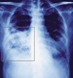 Radiographie pulmonaire - crédits : © James Cavallini / Photo Researchers