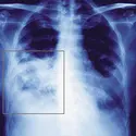 Radiographie pulmonaire - crédits : © James Cavallini / Photo Researchers
