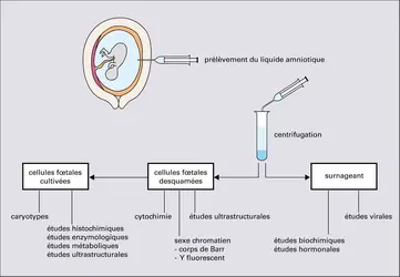 Diagnostic prénatal par amniocentèse - crédits : Encyclopædia Universalis France