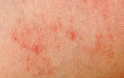 Réaction allergique cutanée - crédits : © Pan Xunbin/ Shutterstock