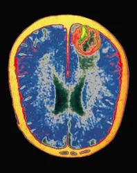 Image d'une lésion du cerveau - crédits : © Airelle-Joubert/Photo Researchers, Inc.