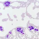 Globules blancs dans une leucémie - crédits : © Vetpathologist/ Shutterstock