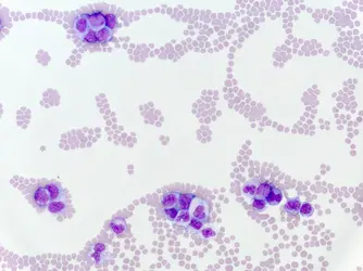 Globules blancs dans une leucémie - crédits : © Vetpathologist/ Shutterstock