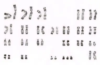 Caryotype d'une trisomie 22 - crédits : © NHGRI