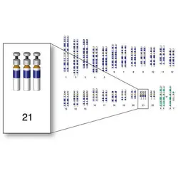 Caryotype d'une trisomie 21 - crédits : © NHGRI